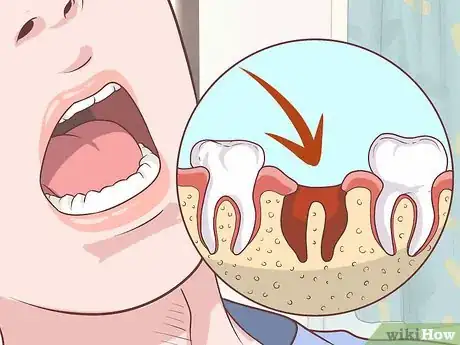 Imagem intitulada Prepare for Tooth Extraction Step 17