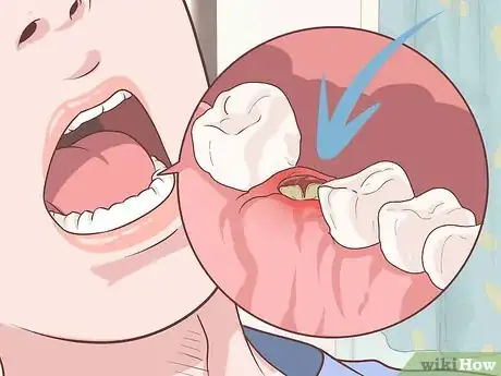 Imagem intitulada Prepare for Tooth Extraction Step 13