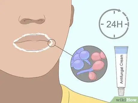 Imagem intitulada Cure Angular Cheilitis Step 9
