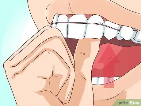 Imagem intitulada Put on a Retainer Step 5