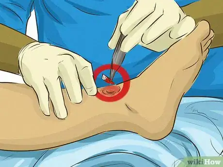 Imagem intitulada Stop Bleeding Step 17