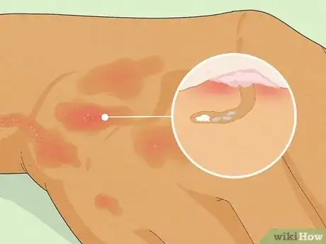 Imagem intitulada Recognize Scabies Rash Step 7