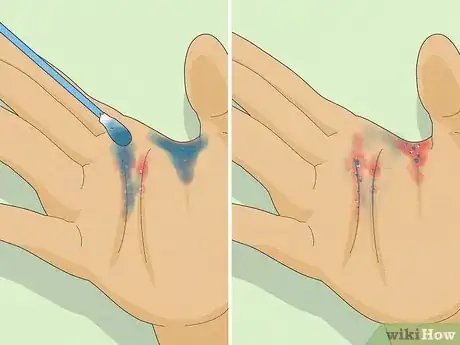 Imagem intitulada Recognize Scabies Rash Step 6