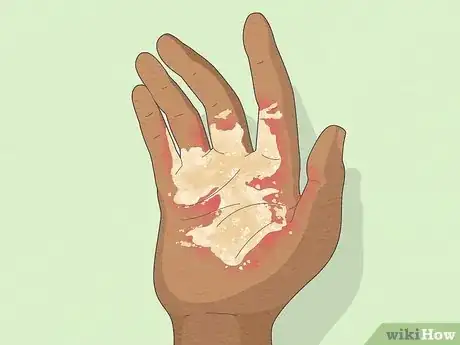 Imagem intitulada Recognize Scabies Rash Step 4