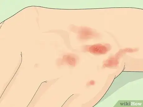 Imagem intitulada Recognize Scabies Rash Step 1