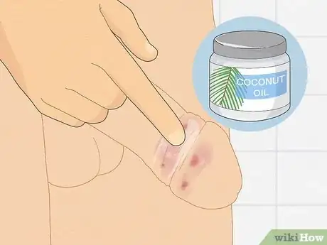 Imagem intitulada Cure Balanitis Step 4