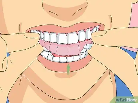 Imagem intitulada Clean Invisalign Step 11