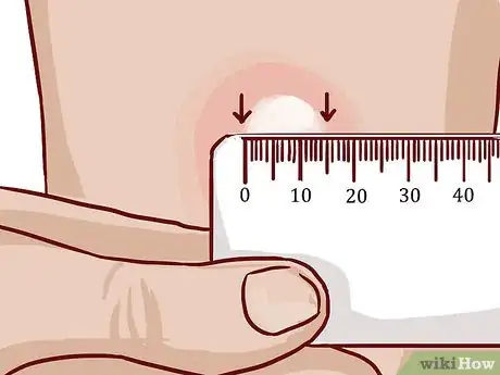 Imagem intitulada Read a Tuberculosis Skin Test Step 7