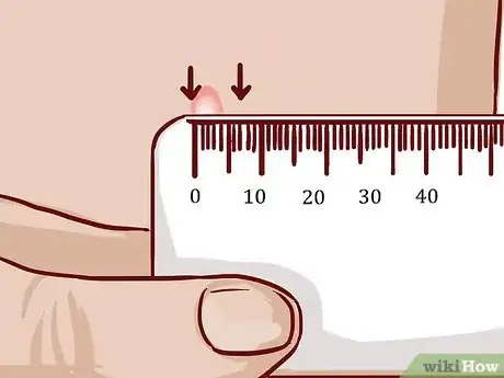 Imagem intitulada Read a Tuberculosis Skin Test Step 9