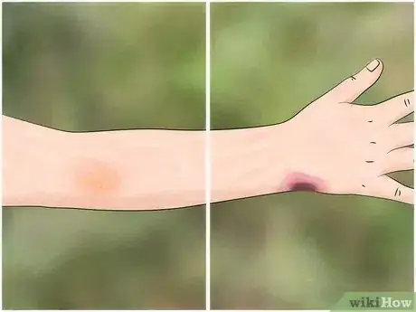 Imagem intitulada Identify a Spider Bite Step 4