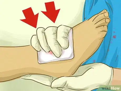 Imagem intitulada Stop Bleeding Step 18