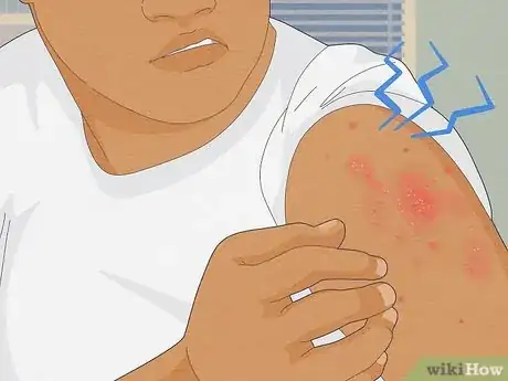 Imagem intitulada Recognize Scabies Rash Step 2