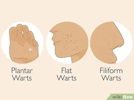 Imagem intitulada Identify Warts Step 2