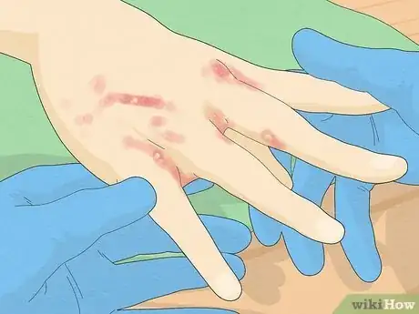 Imagem intitulada Recognize Scabies Rash Step 5