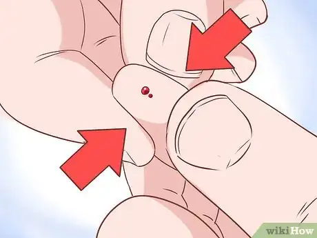 Imagem intitulada Remove a Splinter Step 9