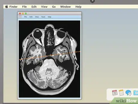 Imagem intitulada Read an MRI Step 10