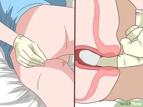 Imagem intitulada Insert a Rectal Suppository Step 8