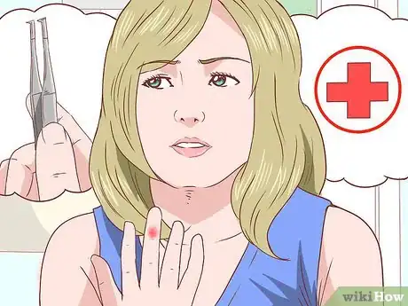 Imagem intitulada Remove a Splinter Step 1