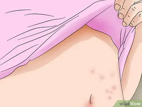 Imagem intitulada Identify Bed Bug Bites Step 2