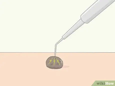 Imagem intitulada Remove Moles Quickly Step 7