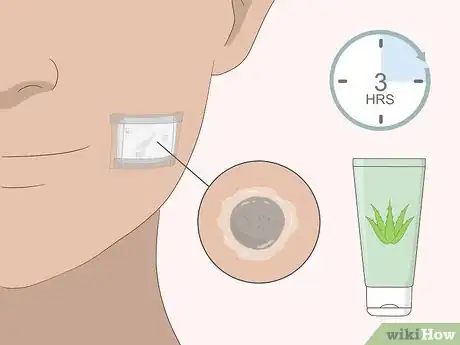 Imagem intitulada Remove Moles Quickly Step 8