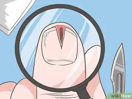 Imagem intitulada Remove a Deep Splinter Step 17