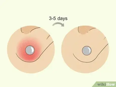 Imagem intitulada Treat Infected Piercings Step 13