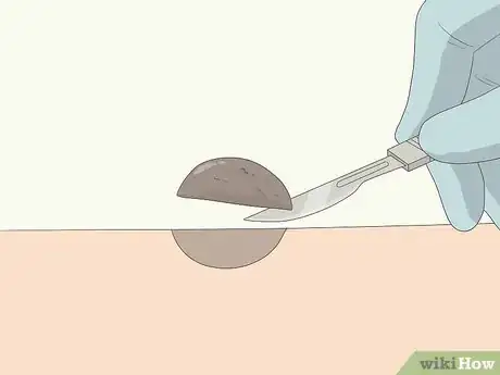 Imagem intitulada Remove Moles Quickly Step 3