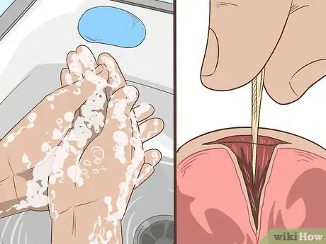 Imagem intitulada Remove a Deep Splinter Step 12