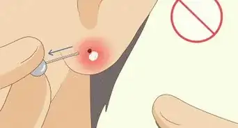 Tratar Piercings Infeccionados