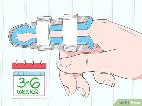 Imagem intitulada Fix a Dislocated Finger Step 8