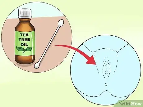 Imagem intitulada Stop Vaginal Itching Step 7